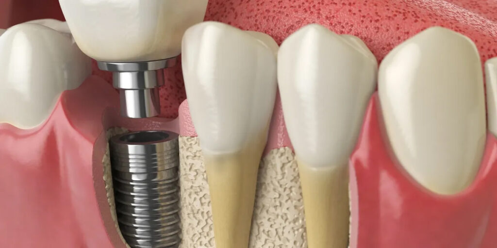 implants procedure and surgery